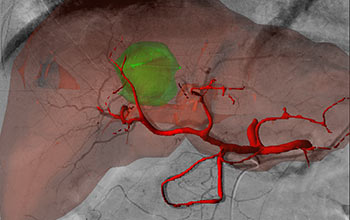 Augmented Reality for Surgery