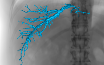 Augmented Fluoroscopy